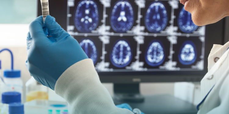 Os 5 maiores avanços no tratamento do Alzheimer nos últimos anos 