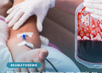 SUS aprova novos tratamentos para anemia por deficiência de ferro, mas protocolo desatualizado mantém distância entre incorporação e acesso