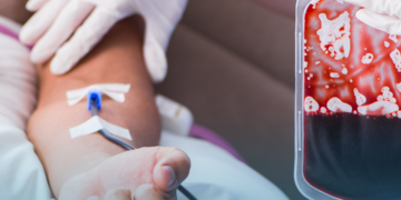 SUS aprova novos tratamentos para anemia por deficiência de ferro, mas protocolo desatualizado mantém distância entre incorporação e acesso 