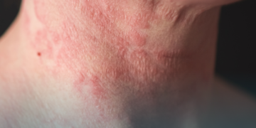 Dia da Dermatite Atópica: Doença inflamatória crônica da pele impacta na qualidade de vida dos pacientes e convívio social