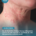 Dia da Dermatite Atópica: Doença inflamatória crônica da pele impacta na qualidade de vida dos pacientes e convívio social