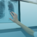 Medicamento que revolucionou o tratamento da hipertensão pulmonar pode entrar no SUS