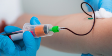 Anvisa aprova exame de sangue para diagnosticar Doença de Alzheimer