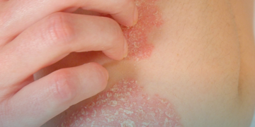Dia Mundial da Psoríase: dermatologista da SBCD explica como reconhecer a doença e quais cuidados adotar